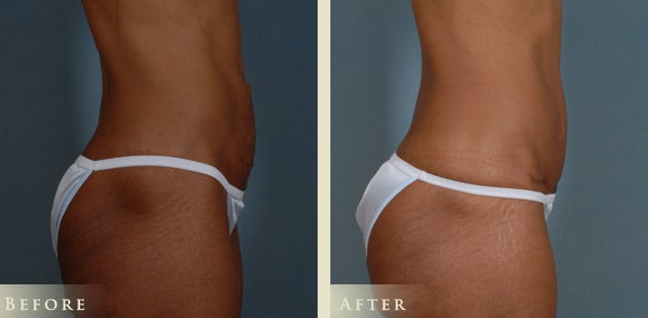 Mommy Makeover Before & After Gallery - Patient 338837 - Image 5