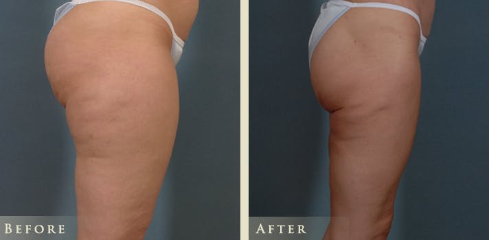 Female Liposuction Before & After Gallery - Patient 207953 - Image 3