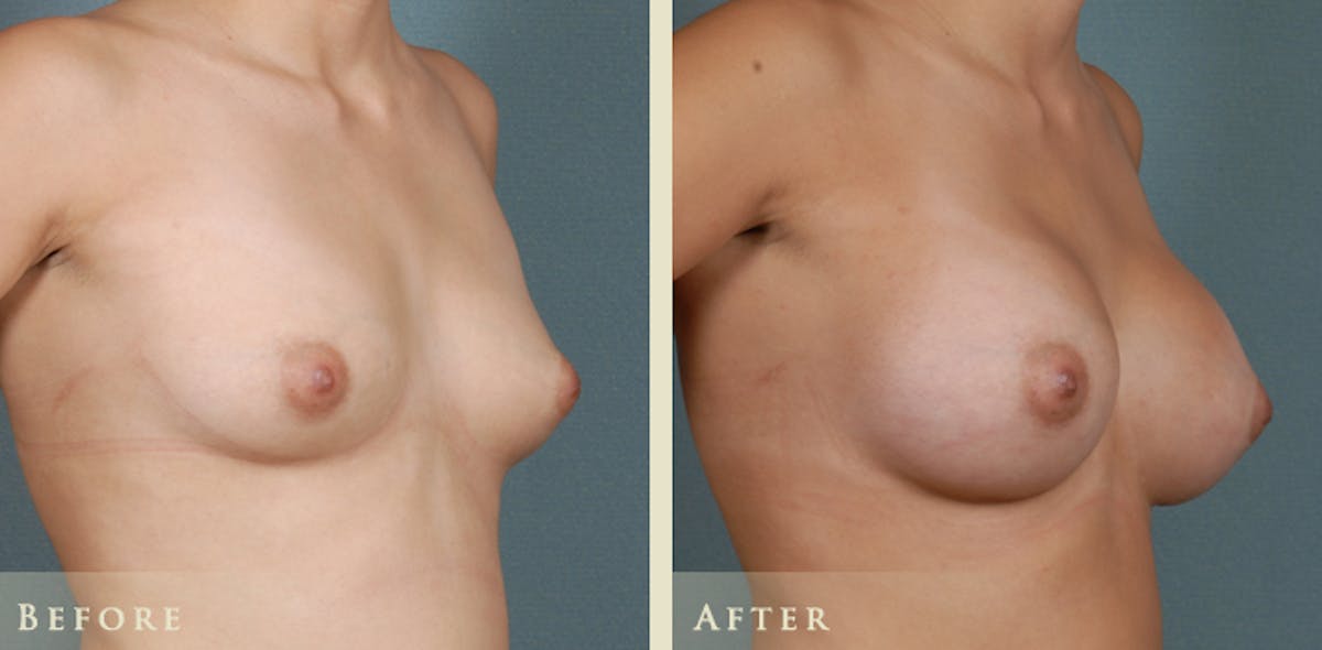 Breast Augmentation with Saline Implants Before & After Gallery - Patient 414123 - Image 2