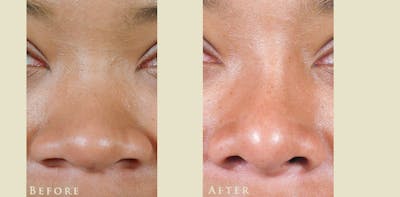 Aesthetic Rhinoplasty Before & After Gallery - Patient 336197 - Image 1