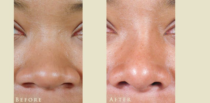 Aesthetic Rhinoplasty Before & After Gallery - Patient 336197 - Image 1