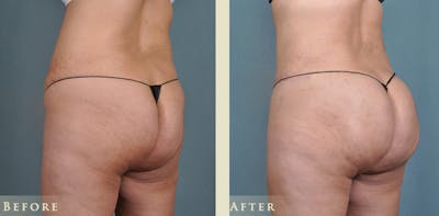 Tummy Tuck Before & After Gallery - Patient 176365 - Image 4