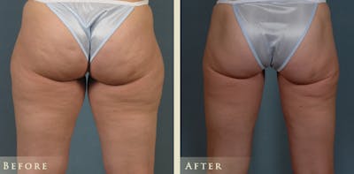 Female Liposuction Before & After Gallery - Patient 207953 - Image 4