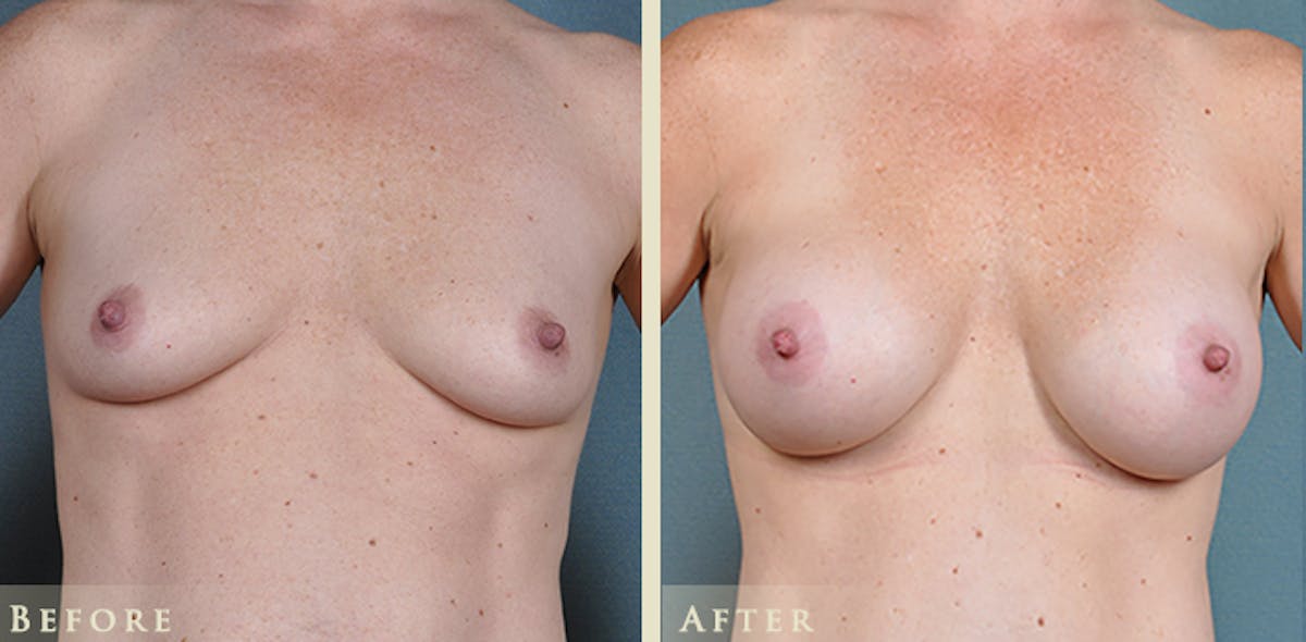 Breast Augmentation with Silicone Implants Before & After Gallery - Patient 274342 - Image 1
