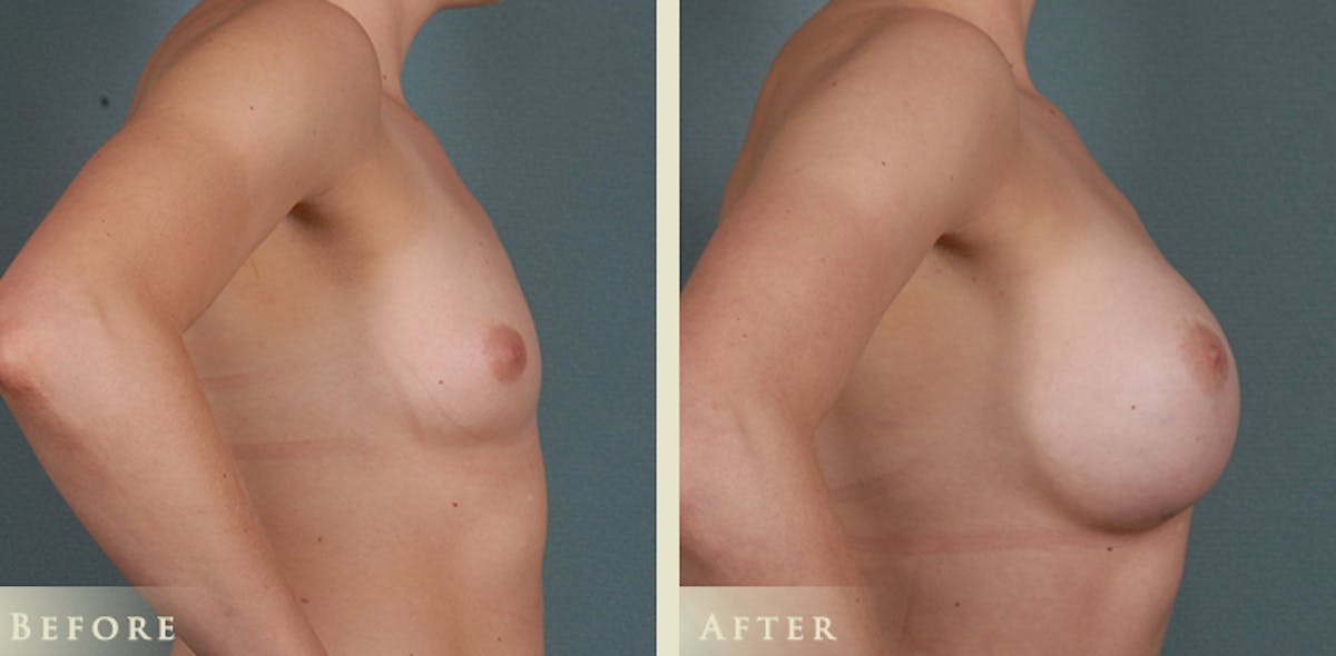 Breast Augmentation with Anatomical Silicone Implants Before & After Gallery - Patient 241911 - Image 5