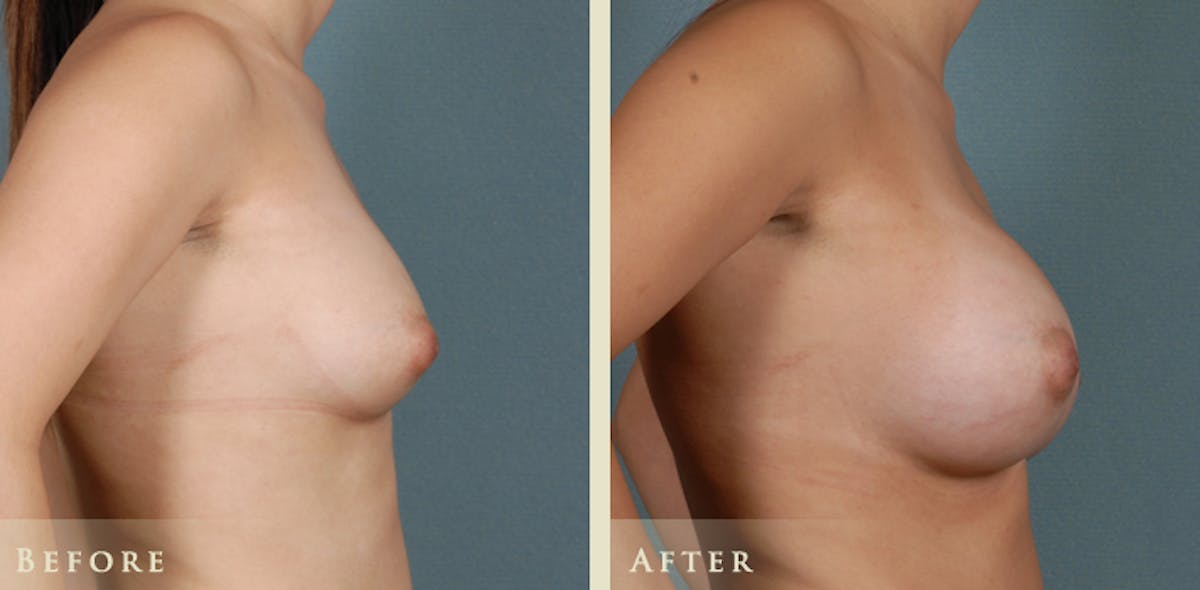Breast Augmentation with Saline Implants Before & After Gallery - Patient 414123 - Image 3