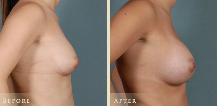 Breast Augmentation Before & After Gallery - Patient 218421 - Image 3