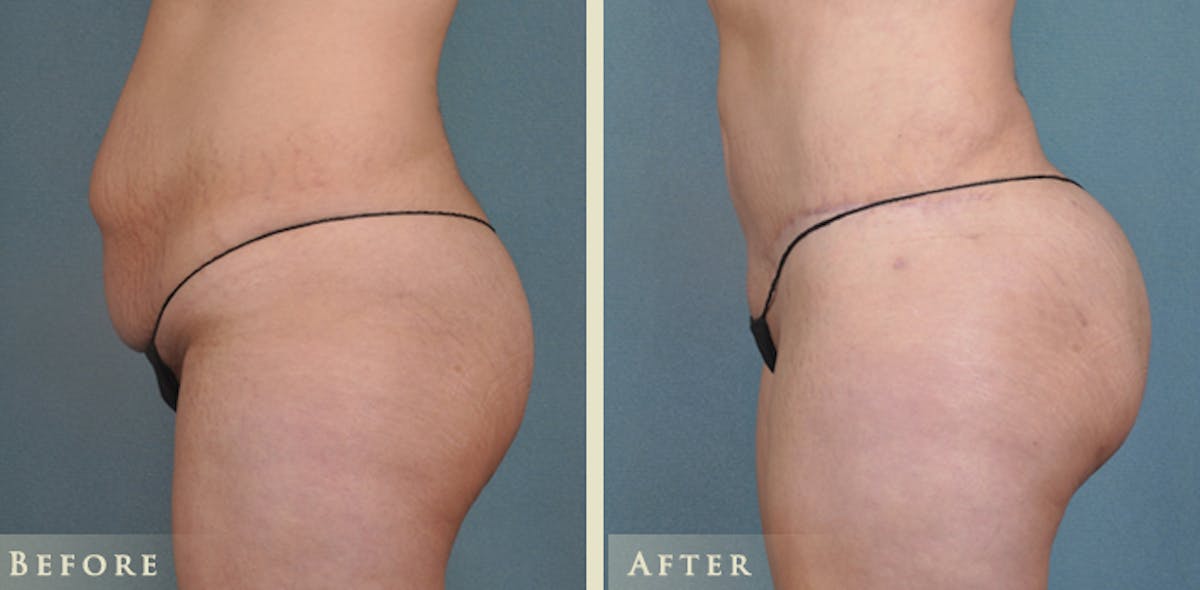 Brazilian Butt Lift Before & After Gallery - Patient 425165 - Image 1