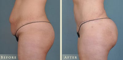 Brazilian Butt Lift Before & After Gallery - Patient 425165 - Image 1