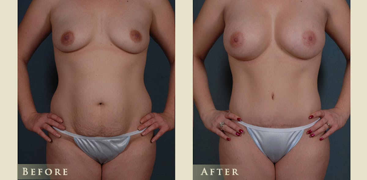 Mommy Makeover Before & After Gallery - Patient 296657 - Image 1