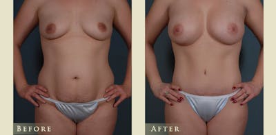Mommy Makeover Before & After Gallery - Patient 296657 - Image 1