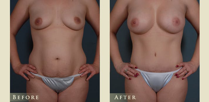 Mommy Makeover Before & After Gallery - Patient 296657 - Image 1