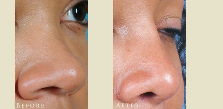 Aesthetic Rhinoplasty Before & After Gallery - Patient 336197 - Image 2