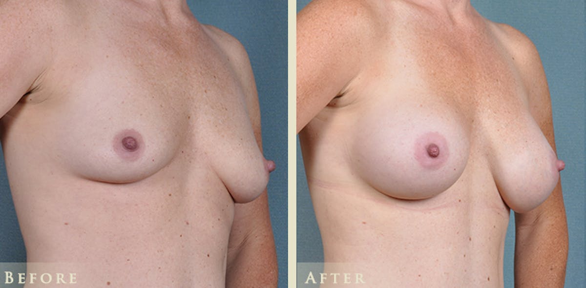 Breast Augmentation with Silicone Implants Before & After Gallery - Patient 274342 - Image 2