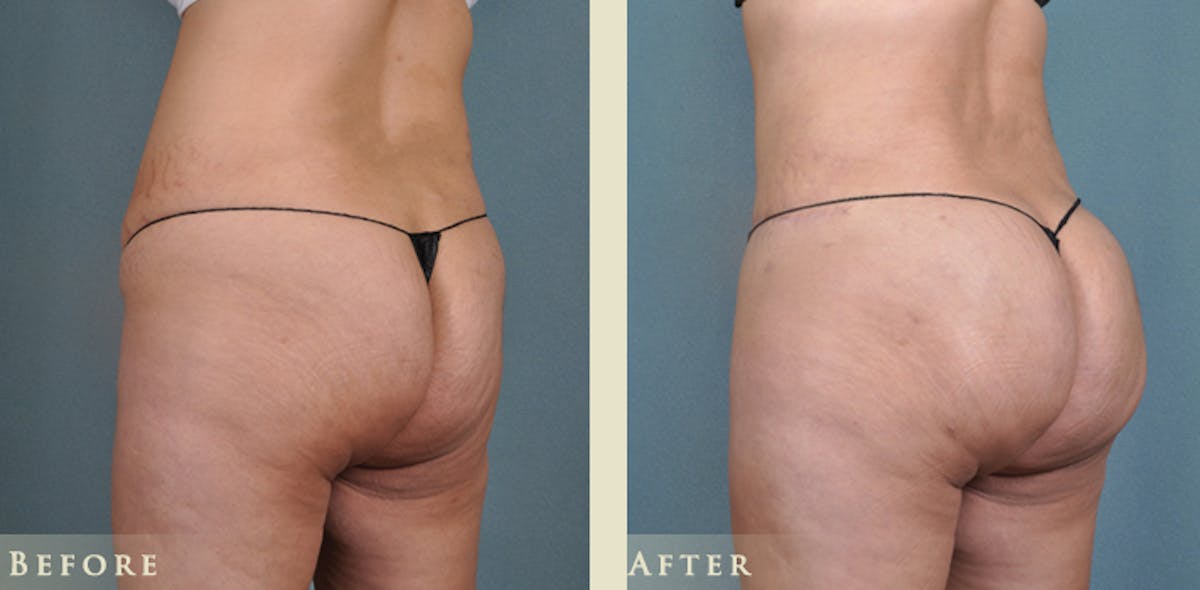 Brazilian Butt Lift Before & After Gallery - Patient 425165 - Image 2