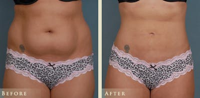 Female Liposuction Before & After Gallery - Patient 373122 - Image 1