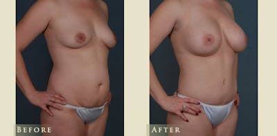 Mommy Makeover Before & After Gallery - Patient 296657 - Image 2