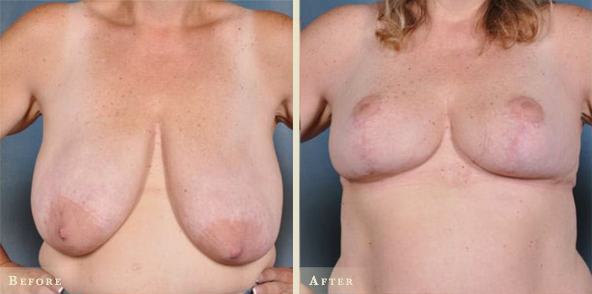 Breast Lift and Reduction Before & After Gallery - Patient 195629 - Image 1