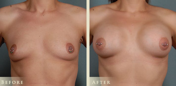 Breast Augmentation Before & After Gallery - Patient 147231 - Image 1