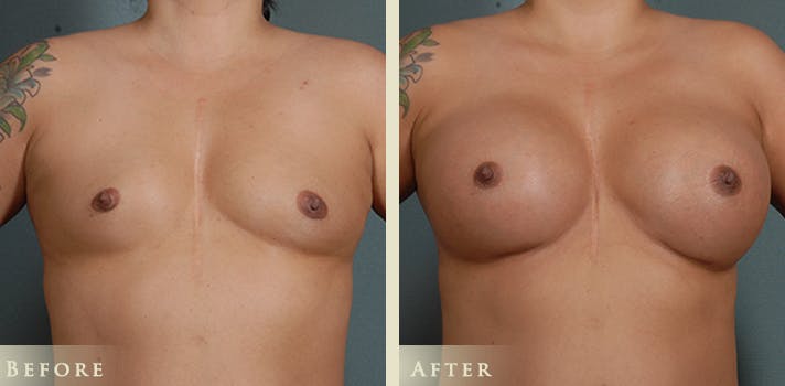 Breast Augmentation Before & After Gallery - Patient 190436 - Image 1