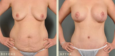 Tummy Tuck Before & After Gallery - Patient 247890 - Image 1