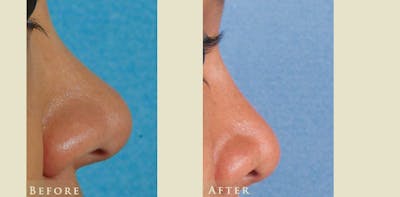Aesthetic Rhinoplasty Before & After Gallery - Patient 336197 - Image 3