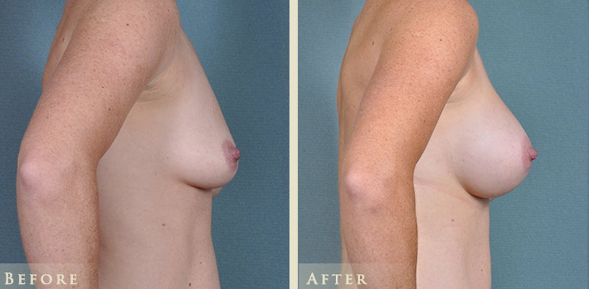 Breast Augmentation with Silicone Implants Before & After Gallery - Patient 274342 - Image 3