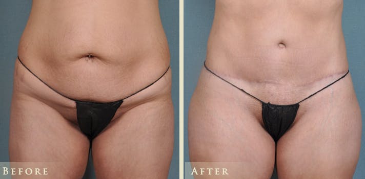 Brazilian Butt Lift Before & After Gallery - Patient 425165 - Image 3