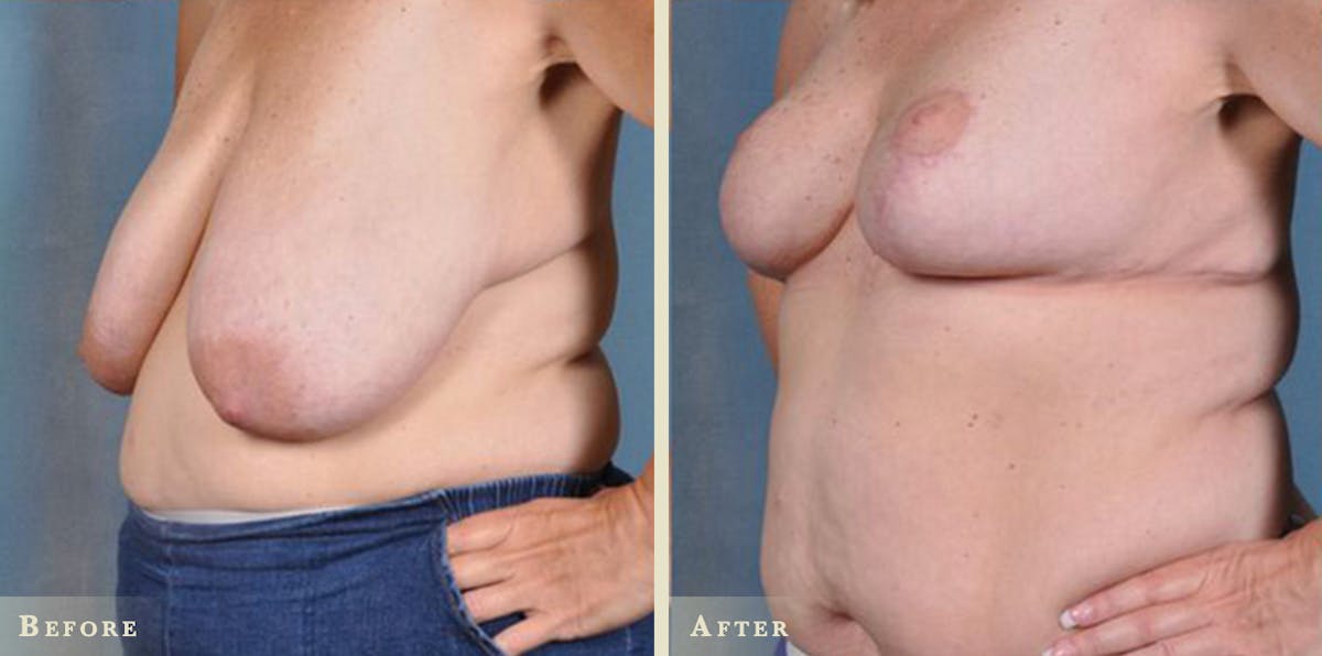 Breast Lift and Reduction Before & After Gallery - Patient 195629 - Image 2