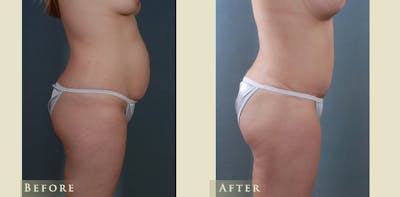 Mommy Makeover Before & After Gallery - Patient 296657 - Image 3