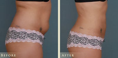 Female Liposuction Before & After Gallery - Patient 373122 - Image 2