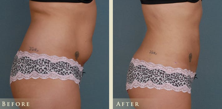 Female Liposuction Before & After Gallery - Patient 373122 - Image 2