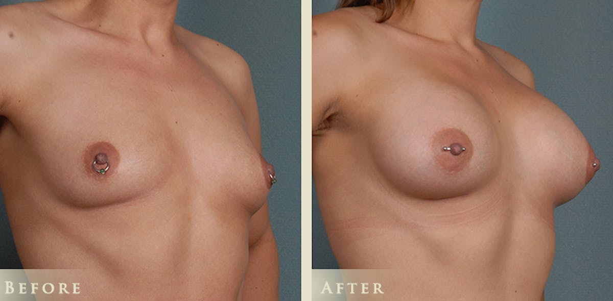 Breast Augmentation with Anatomical Silicone Implants Before & After Gallery - Patient 226808 - Image 2