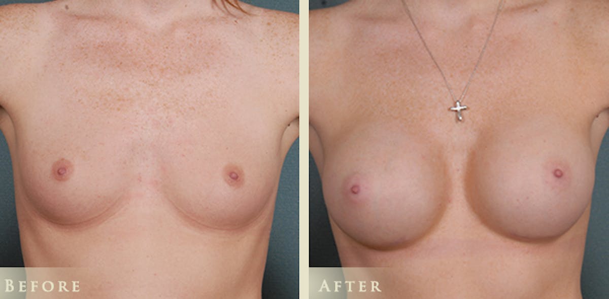 Breast Augmentation with Silicone Implants Before & After Gallery - Patient 169398 - Image 1