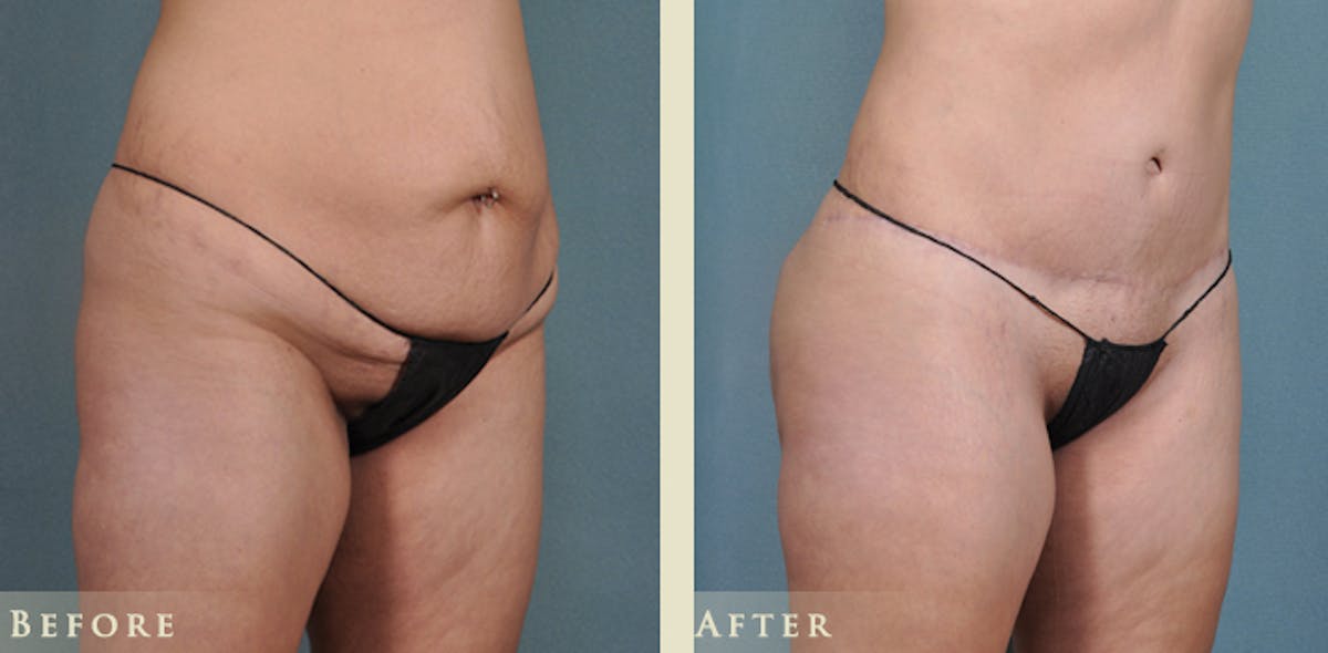 Brazilian Butt Lift Before & After Gallery - Patient 425165 - Image 4