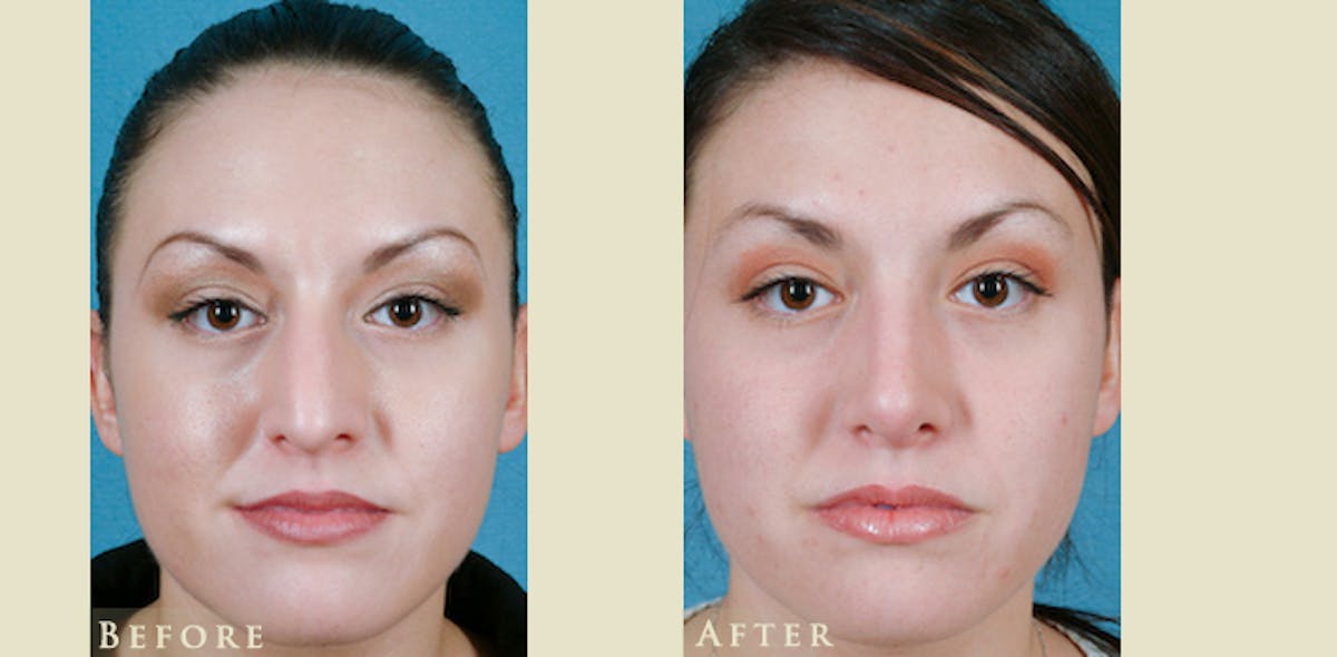 Aesthetic Rhinoplasty Before & After Gallery - Patient 358351 - Image 1