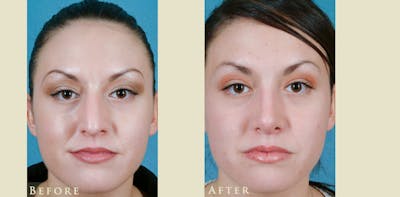 Aesthetic Rhinoplasty Before & After Gallery - Patient 358351 - Image 1