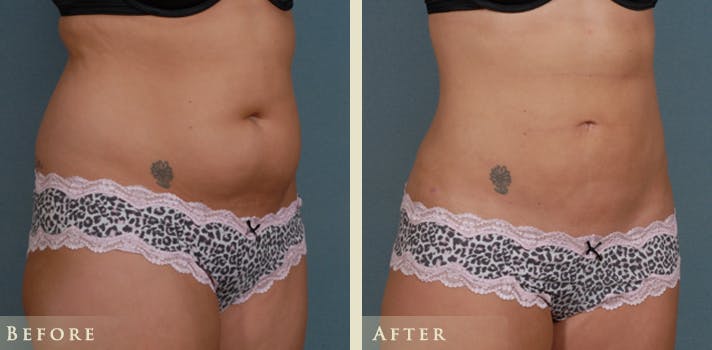Female Liposuction Before & After Gallery - Patient 373122 - Image 3