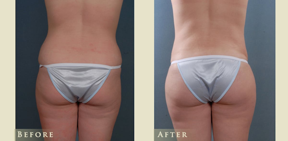 Mommy Makeover Before & After Gallery - Patient 296657 - Image 4