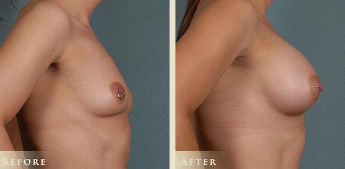 Breast Augmentation with Anatomical Silicone Implants Before & After Gallery - Patient 226808 - Image 3