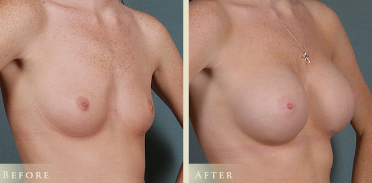 Breast Augmentation with Silicone Implants Before & After Gallery - Patient 169398 - Image 2