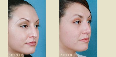 Aesthetic Rhinoplasty Before & After Gallery - Patient 358351 - Image 2