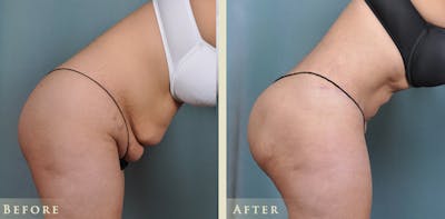 Brazilian Butt Lift Before & After Gallery - Patient 425165 - Image 5