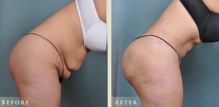 Brazilian Butt Lift Before & After Gallery - Patient 425165 - Image 5