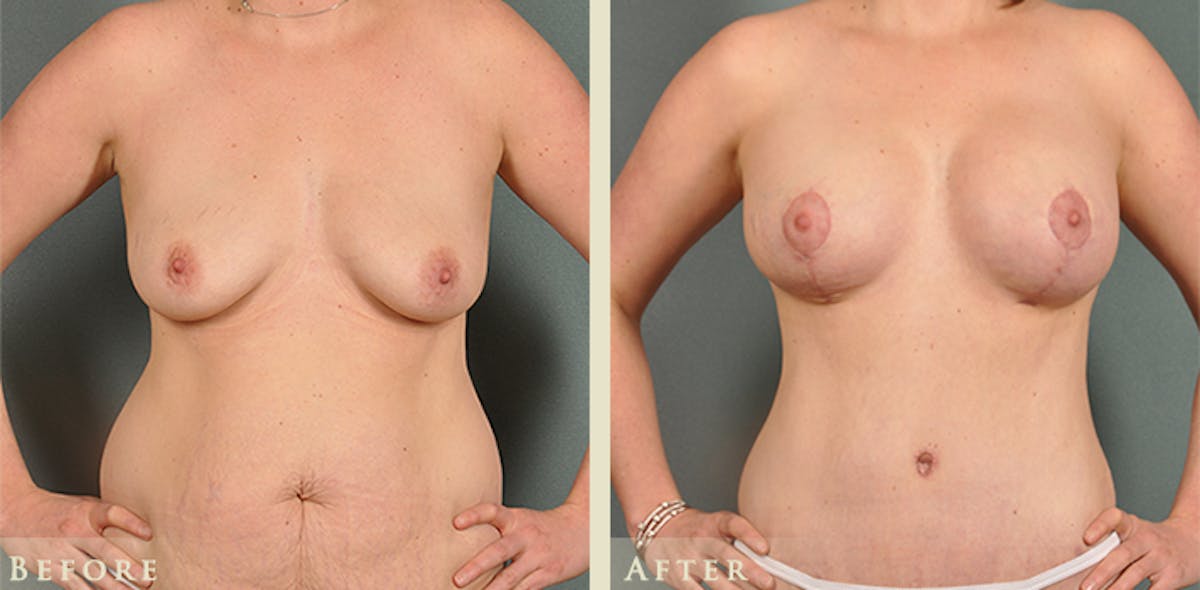 Breast Augmentation and Lift  Before & After Gallery - Patient 203292 - Image 2
