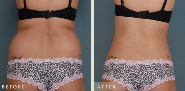 Female Liposuction Before & After Gallery - Patient 373122 - Image 4