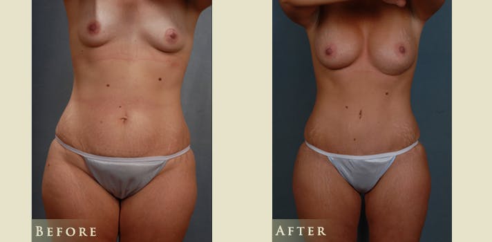 Mommy Makeover Before & After Gallery - Patient 528835 - Image 1
