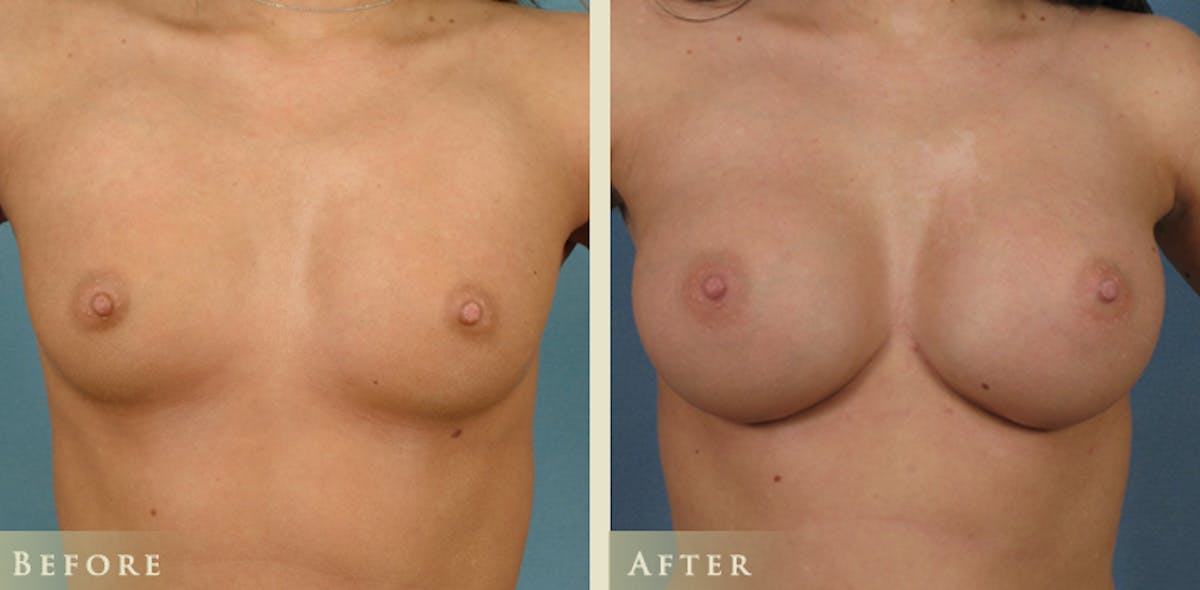 Breast Augmentation with Saline Implants Before & After Gallery - Patient 242784 - Image 1