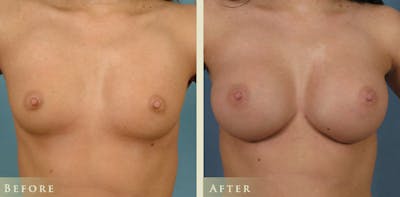 Breast Augmentation Before & After Gallery - Patient 108090 - Image 1
