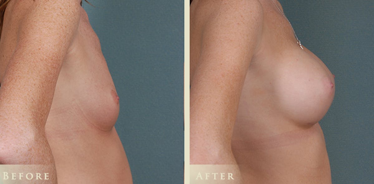Breast Augmentation with Silicone Implants Before & After Gallery - Patient 169398 - Image 3
